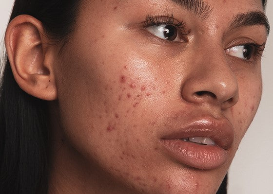 What is hyperpigmentation and how to treat it?